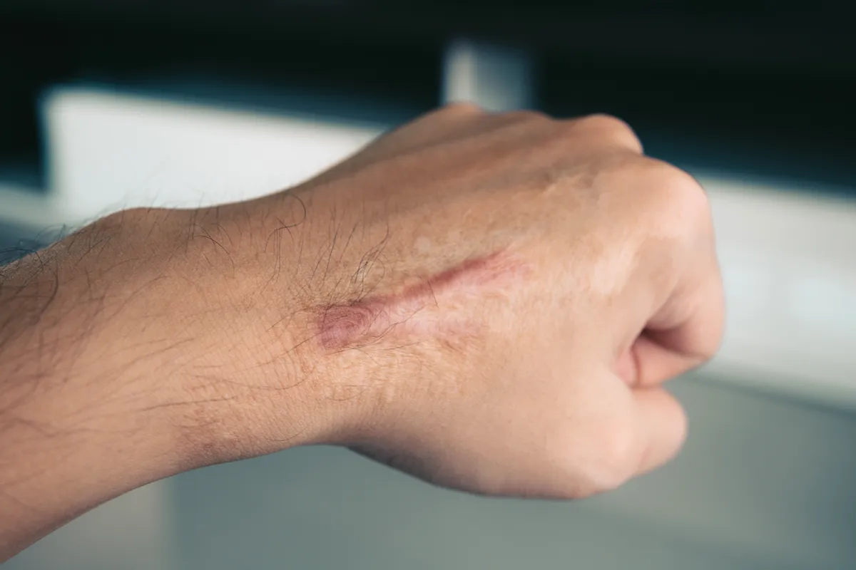 someone has a bruised arm and arm with a black spot on it